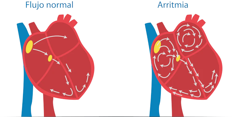 arritmia_cardiaca-clinica-insuficiencia-cardia