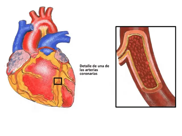 cardiopatia-isquemica-clinica-de-insuficiencia-cardiaca