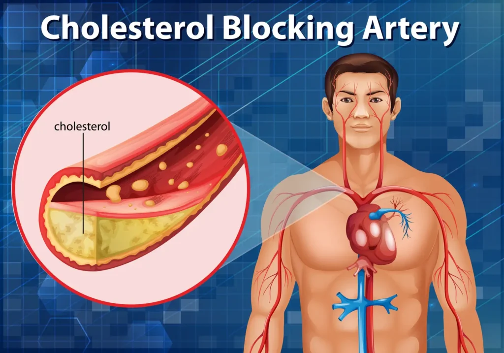 ¿Tienes el colesterol alto? Descubre qué significa y cómo bajarlo 1 colesterol alto Imagen del corazón con arterias afectadas por colesterol alto - clinica de insuficiencia cardiaca